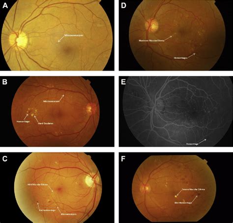 Fundus Photographs And Fluorescein Angiogram Showing Features Of Mild