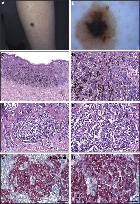 Impact Of Second Opinion Pathology Review In The Diagnosis And