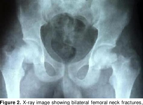 Figure 1 From Simultaneous Bilateral Femoral Neck Fractures After