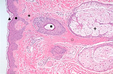 Xeroderma Pigmentosum Histology