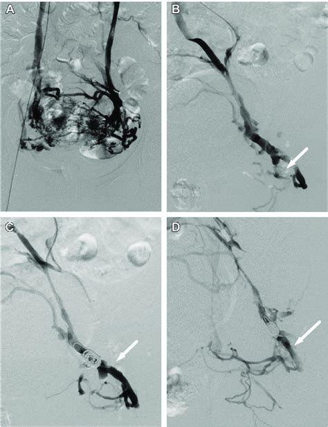 Proximal Coil Occlusion Preceding Distal Sclerotherapy PCODS