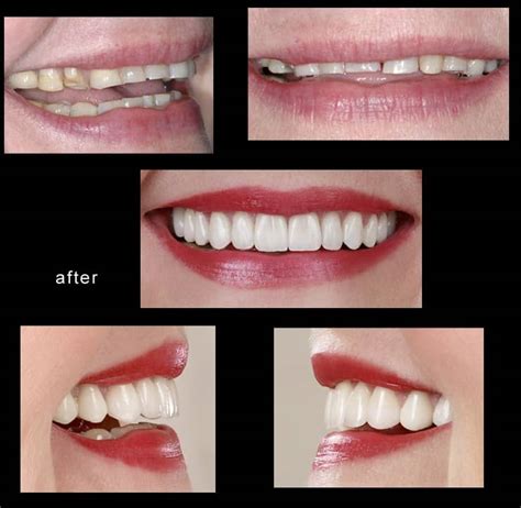 Lumineers Vs Veneers Smile Design Dental Practice Dentist In