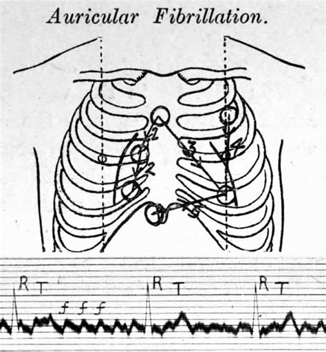 Lewis Lead Ecg Placement