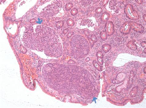 Squamous Cell Carcinoma Digestive Tract: Symptoms, Causes, And ...