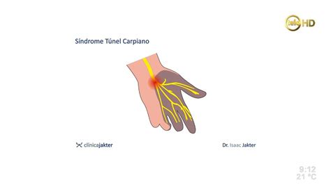 Tratamiento del síndrome del túnel carpiano Dr Isaac Jakter YouTube