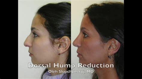 Hump Reduction Rhinoplasty Youtube