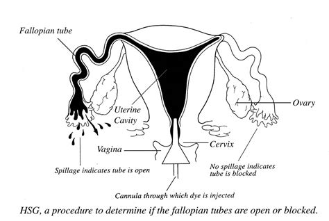 Hsg Hysterosalpingogram Klinika Papić