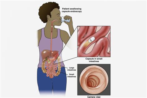 Small Bowel Capsule Endoscopy – Gastrocare Hospital