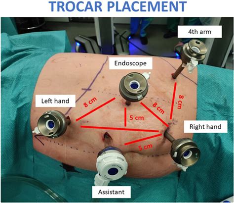 V01 06 Robot Assisted Pyeloplasty With The Novel Hugotm Ras System Surgical Setup At A High