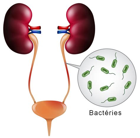 L Infection Urinaire Chez La Femme