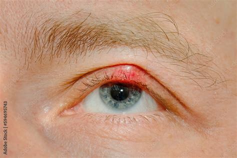 Eye Sick Eyelid Sick Demodicosis Mite Diseas Demodex Chalazion On