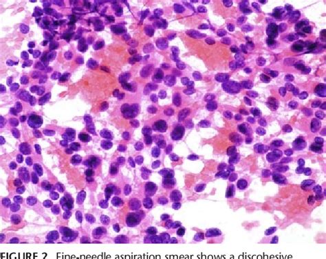 Figure 1 From Diagnostic Pitfalls In Fine Needle Aspiration Of