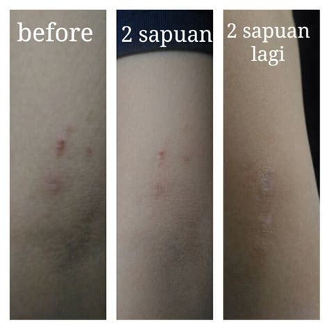 Hilangkan Parut Dengan Czer Scar Powder