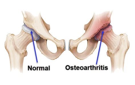 arthrose hanche | OsteoMag