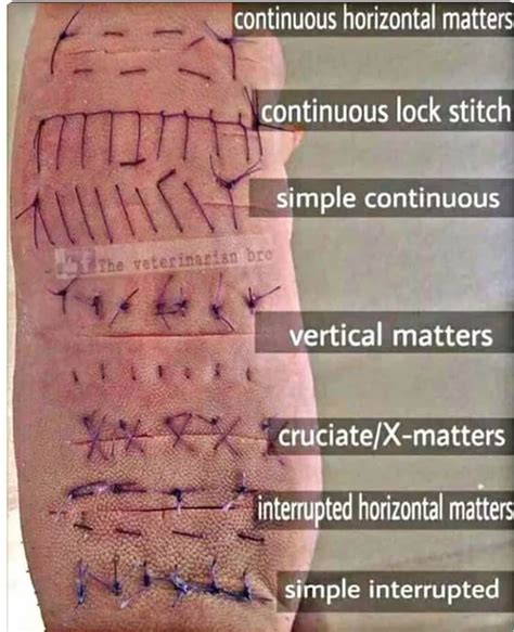 Oren Gottfried MD On Twitter Sutures Will Not Look Perfect To Start