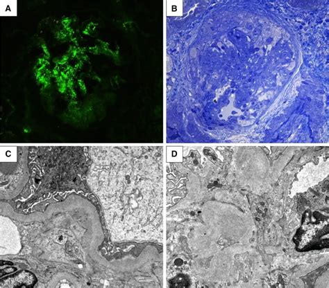 A Immunofluorescence Microscopy Image Shows Intense Mesangial Iga