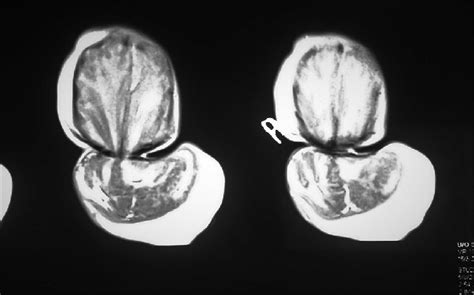 Computed Tomography Scan Showing Giant Encephalocele With Brain Matter