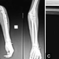 Pre Op And Post Op X Rays Of Elbow And Wrist A Pre Op X Ray B