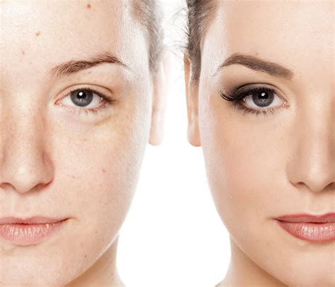 Microdermabrasion Vs Chemical Peel