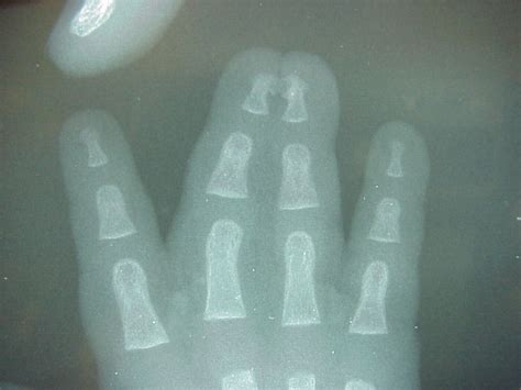 Birth Bilateral Complete Syndactyly Release With Toe Pulp Grafts For