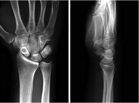 How To Read Wrist Xrays Ortho Conditioning