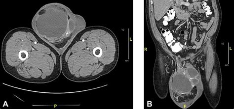 Axial A And Sagittal B Ct Of Abdomen And Pelvis With Oral And Download Scientific Diagram