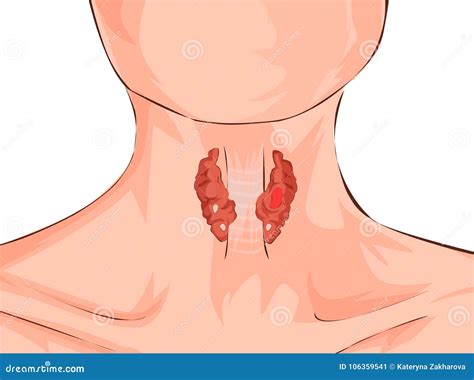 Hipertiroidismo Y Tr Quea Mostrados En Una Mujer Concepto M Dico