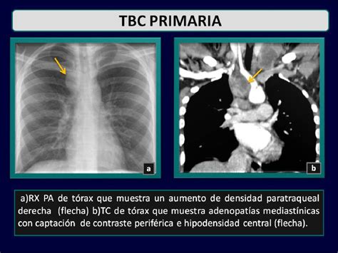 Figure From Manifestaciones Radiol Gicas De La Tuberculosis Pulmonar