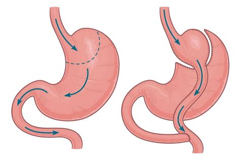 Gastric Bypass Tops Banding For T2d Remission Medpage Today Free