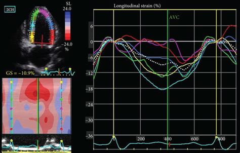 A Representative Example Of Measurements Of Global Longitudinal Strain