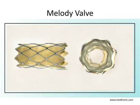 Ppt Role Of Interventional Catheterization In Post Operative Tof