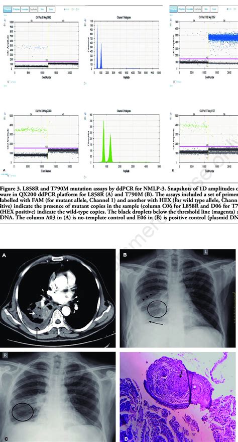 Imaging And Histopathological Features Of NMLP 1 A Axial CT Image