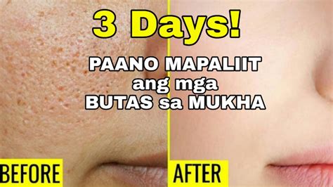 How To Get Rid Of Large Open Pores Permanently In 3 Days Youtube