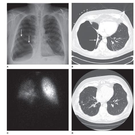 Bullous Disease of the Lung | Thoracic Key