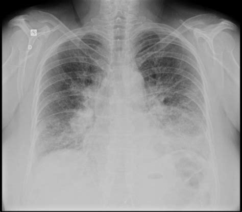 Uti Club 3 Lesión Pulmonar Inducida Por La Ventilación Mecánica