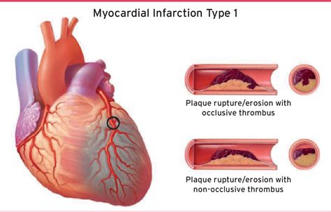 Myocardial Infarction Animation