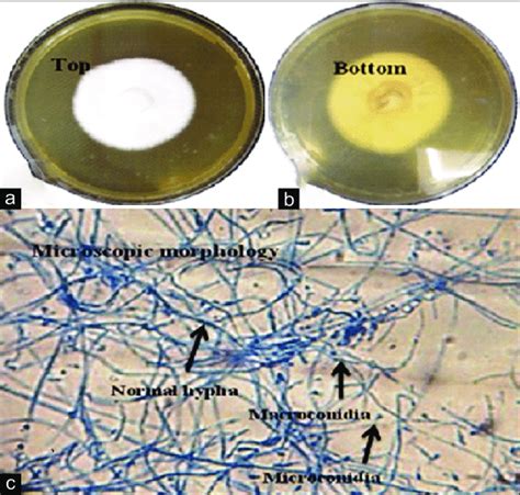 Macroscopy And Microscopy Of Trichophyton Rubrum Growing On Sabouraud