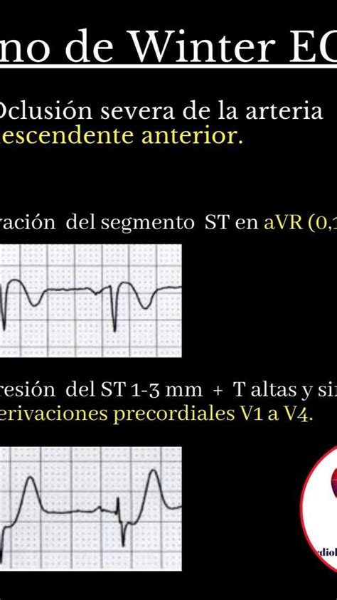 Signo de Winter ECG | Crossword puzzle, Crossword, Puzzle