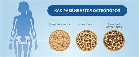 Остеопороз у женщин: методы, способы и средства лечения остеопороза