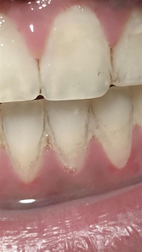 Black Lines On Teeth They Can Be Scratched Off If Needed But What Is