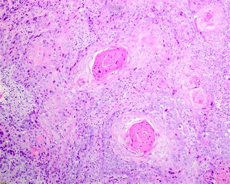 Squamous Cell Carcinoma Lung Keratin Pearls