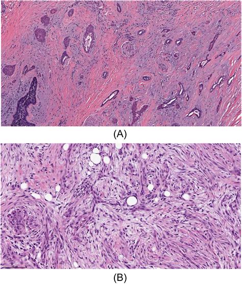 Metaplastic Breast Cancer Current Understanding And Future Directions Clinical Breast Cancer