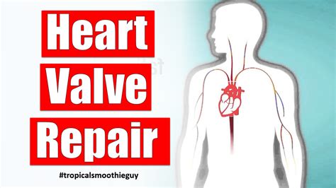 Heart Valve Repair Archives