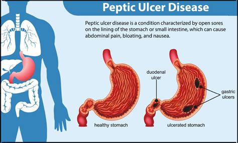 Understanding Peptic Ulcers A Comprehensive Insight Into Symptoms And Effects Thev1bes