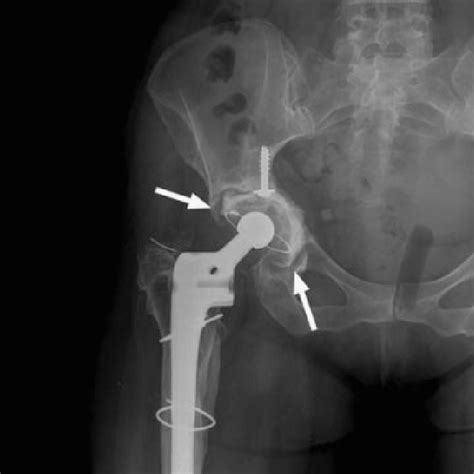 Total Hip Replacement Types