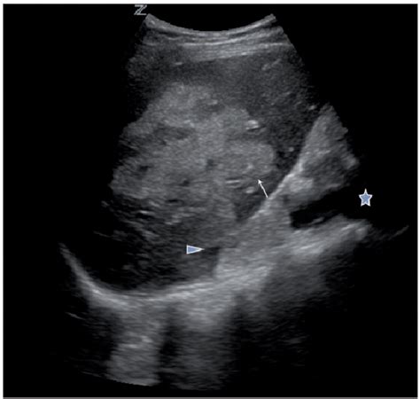 Figure From Fast Identification Of Traumatic Liver Laceration