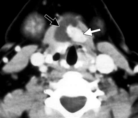 Imaging Of Ectopic Thyroid Tissue And Thyroglossal Duct Cysts