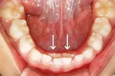 儿童换牙顺序图20颗最全儿童换牙时间表爸妈一定要知道 说明书网