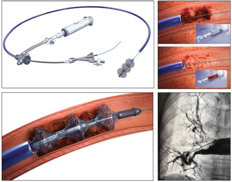 The Search For The Holy Grail Of New PE Devices Endovascular Today