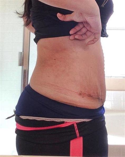 Abdominoplasty Scars Photos Tummy Tuck Prices Photos Reviews Info Qanda